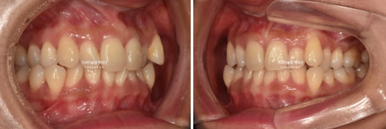 옥니 덧니 과개교합 반대교합 중심선 인비절라인 치료기간 1년 관련 이미지 3