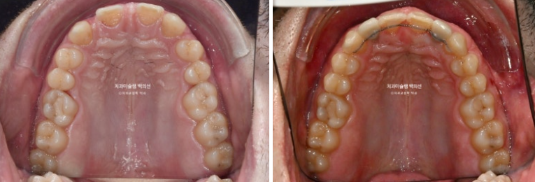 앞니 선천적 결손 인비절라인 임플란트 과개교합 치료 기간 관련 이미지 24