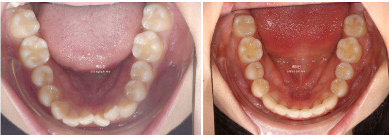 비발치 덧니교정 인비절라인 교정 사랑니 이용 교정 관련 이미지 16
