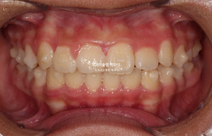 덧니 반대교합 과개교합 인비절라인 퍼스트 악궁확장 어린이 교정 치료 관련 이미지 6