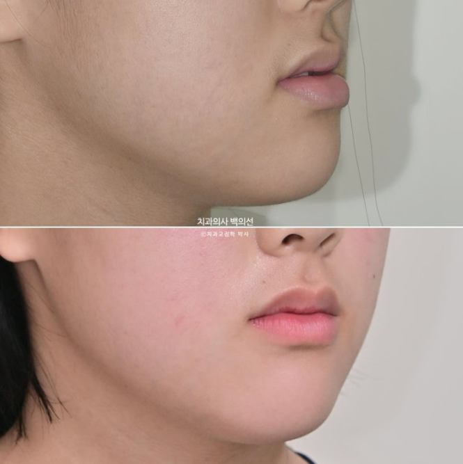 중학생 주걱턱 반대교합 개방교합 덧니 교정 인비절라인 후기 관련 이미지 14