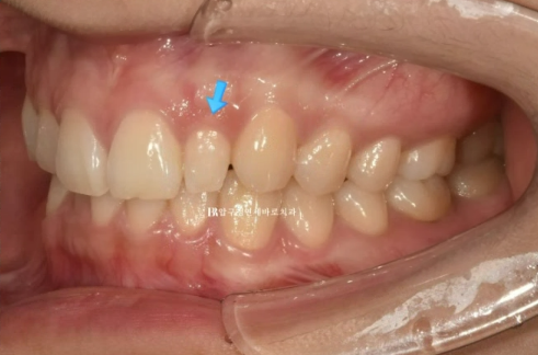 급속 교정 앞니부분교정 치료 무삭제 라미네이트 후기 관련 이미지 4
