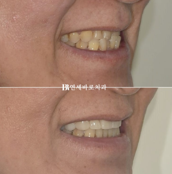60대 무삭제 라미네이트 앞니 부분교정 치료 관련 이미지 13