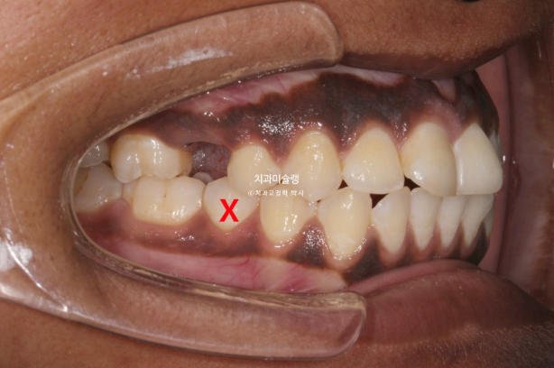 Extraction & re-orthodontics with Clippy-C, intrusion for dental implant. 관련 이미지 6