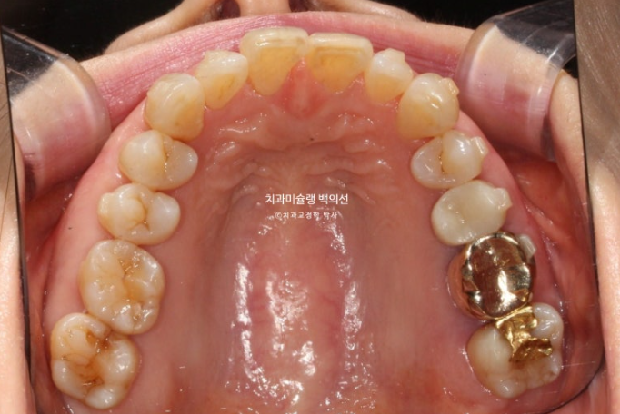 50대 치아교정 중년 발치교정 블랙트라이앵글 치료 후기 관련 이미지 10