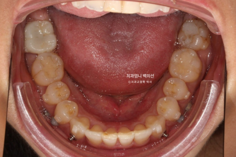 인비절라인 비발치 덧니 교정 반대교합 치료 후기 관련 이미지 8