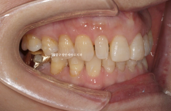 50s Invisalign Lite No-Prep Laminate Bunny Teeth image 11