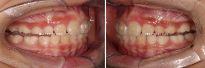 무턱교정 어린이 투명교정 인비절라인 퍼스트 교정 후기 관련 이미지 12