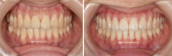 인비절라인 익스프레스 토끼이빨 교정 기간? 인비절라인 종류는? 관련 이미지 10