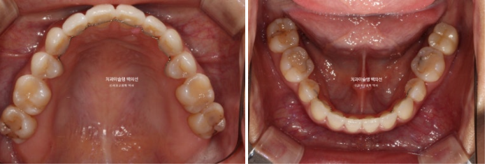인비절라인 익스프레스 재교정 블랙트라이앵글 치간 삭제 치료기간 6개월 재제작 1회 관련 이미지 13