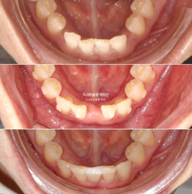 해외거주 앞니 선천적 결손 과개교합 인비절라인 라이트 브릿지 치료 관련 이미지 19