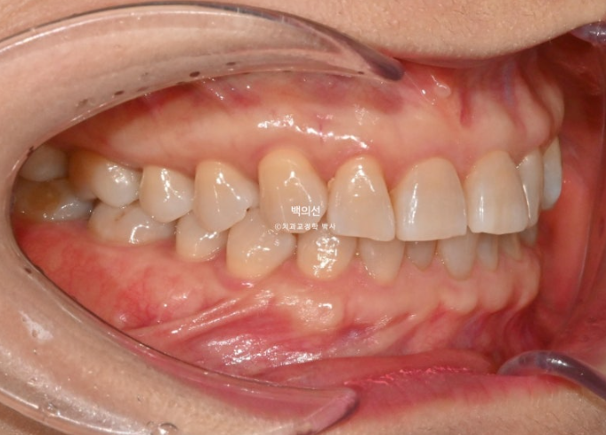 50대 치아교정 :: 인비절라인 익스프레스 치아 벌어짐 단기교정 후기 관련 이미지 4