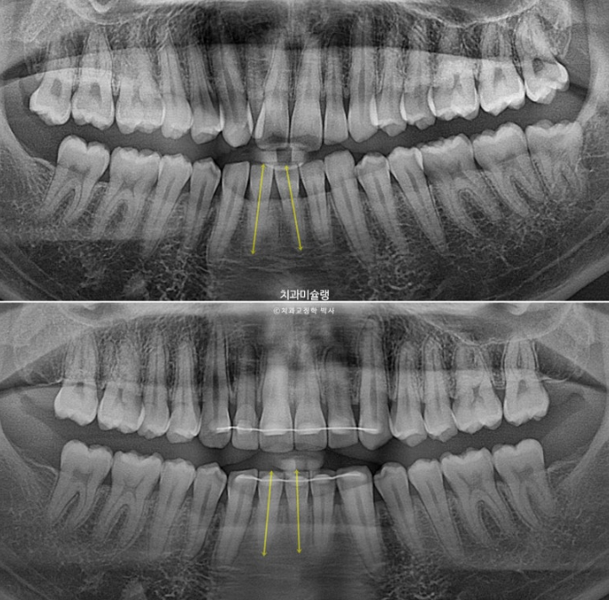 옥니 덧니 교정 왜소치 선천적 결손 3전치 무삭제 라미네이트 인비절라인 교정 관련 이미지 20