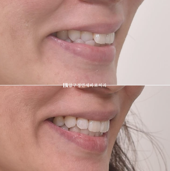 Short-Term Orthodontic Treatment Period for an Overseas Korean in Their 40s with Anterior Crossbite and Buck Teeth image 11