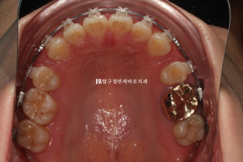 잇몸 미소 거미스마일 교정 후기 | 돌출입 발치교정으로 입매와 미소 개선 관련 이미지 6