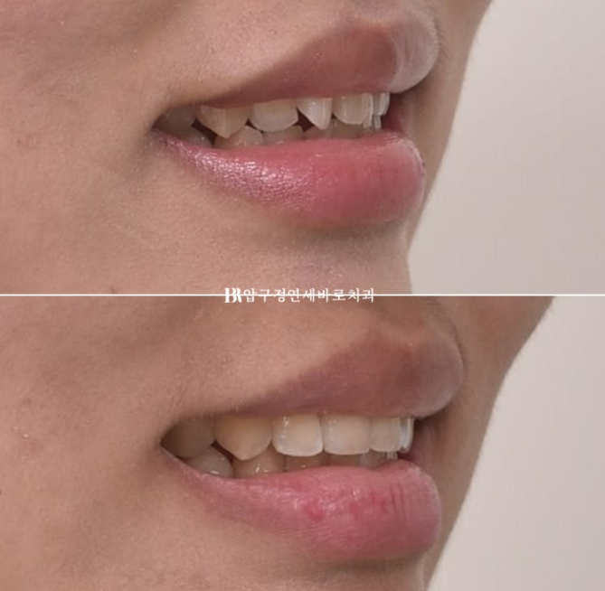 덧니교정 앞니부분교정 치간삭제 후기 관련 이미지 11