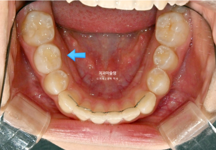 어린이 돌출입 교정 무턱 투명교정 인비절라인 퍼스트 관련 이미지 18