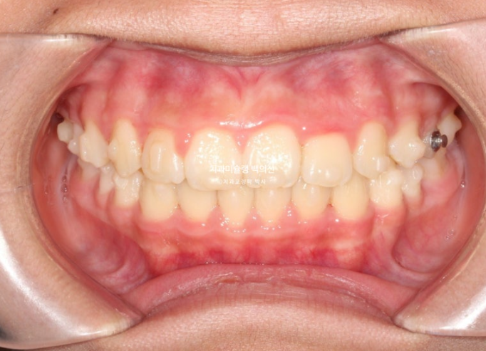 덧니 반대교합 과개교합 인비절라인 퍼스트 악궁확장 어린이 교정 치료 관련 이미지 10