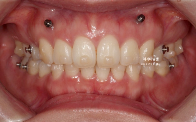돌출입 덧니 발치 교정 인비절라인 교정 후기 관련 이미지 14