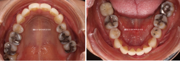 How Can Black Triangles Be Removed? Is Re-treatment Orthodontics an Option? image 3