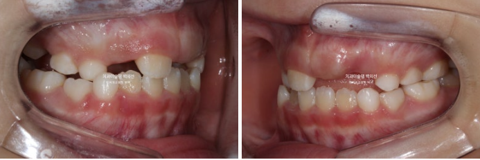 어린이 비대칭 반대교합 주걱턱 인비절라인 퍼스트 프리올소 성장 교정 관련 이미지 7