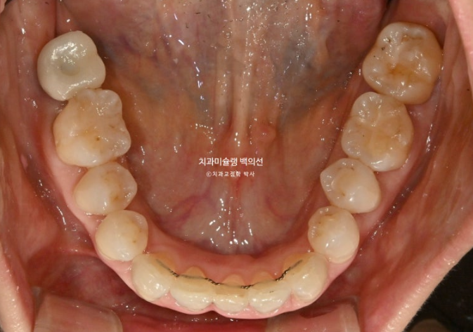 50대 치아교정 중년 발치교정 블랙트라이앵글 치료 후기 관련 이미지 15