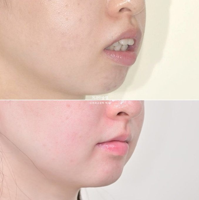 심한 돌출입 입술부전증 호두주름 발치교정 치료 관련 이미지 18