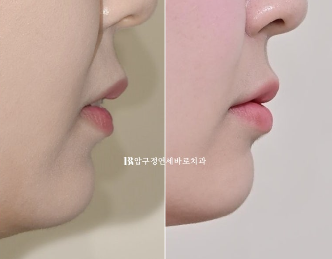 Actual Case of Treating Congenitally Missing and Peg-Shaped Teeth Without Implants image 19
