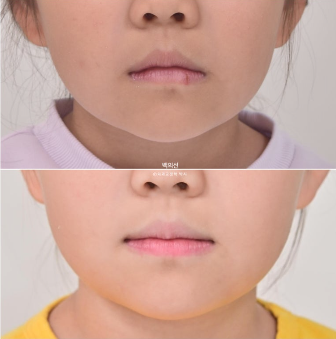소아 비대칭 교정 인비절라인 퍼스트 재제작 1회 MA 치료 관련 이미지 14