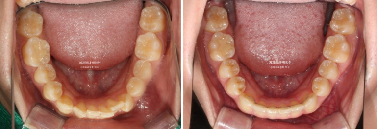 인비절라인 비발치 앞니 돌출 덧니 교정 ? 관련 이미지 16