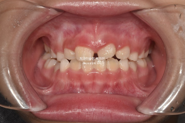 어린이 비대칭 반대교합 주걱턱 인비절라인 퍼스트 프리올소 성장 교정 관련 이미지 8