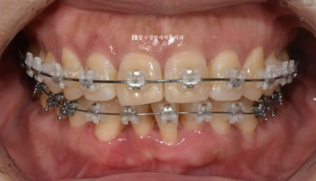 40대 치아교정 가능할까요? 치주염 있어도 치아교정 가능할까요? 임플란트 없이 교정하기 관련 이미지 4