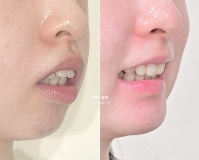 심한 돌출입 입술부전증 호두주름 발치교정 치료 관련 이미지 17