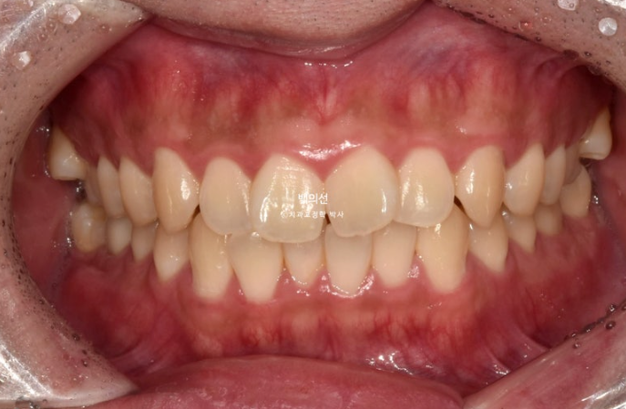 가위교합 나비치아 미니스크류 덧니 교정 인비절라인 라이트 관련 이미지 2