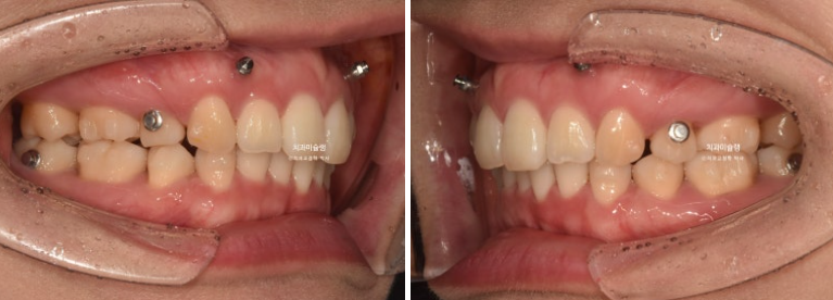 돌출입 덧니 발치 교정 인비절라인 교정 후기 관련 이미지 11