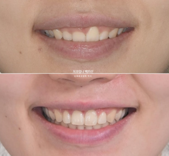 Inward-Tilted Teeth Orthodontic Treatment Review | Actual Case Improved with Non-Extraction Orthodontic Treatment for Gummy Smile, Deep Overbite & Gum Asymmetry — Gangnam Orthodontic Clinic image 18