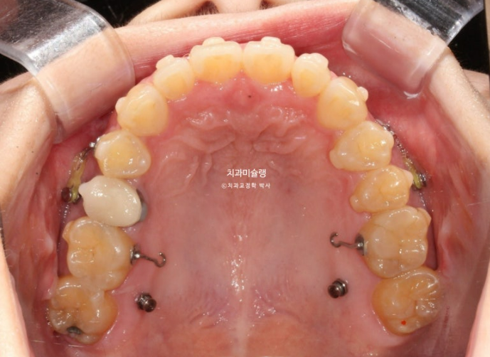비발치 인비절라인 교정 편측 개방교합 가위교합 돌출 재교정 관련 이미지 14