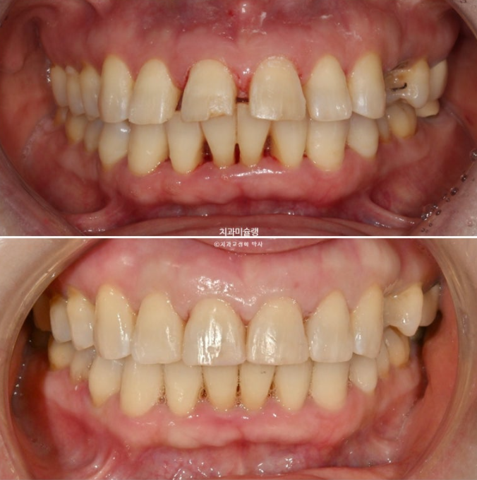 50대 치아교정 돌출 치아벌어짐 중년교정 관련 이미지 16