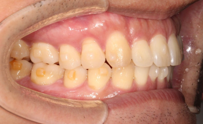 가위교합 벌어짐 중심선 과개교합 인비절라인 라이트 교정 관련 이미지 8