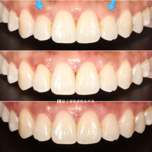 Is compliance important for Invisalign? | A real case that improved reverse bite and scissors bite in 8 months image 9