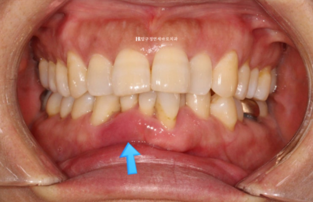 40대 치아교정 가능할까요? 치주염 있어도 치아교정 가능할까요? 임플란트 없이 교정하기 관련 이미지 1