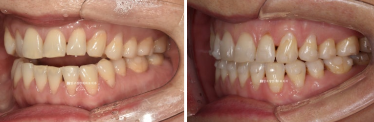 50대 인비절라인 개방교합 합입교정 미니스크류 관련 이미지 7