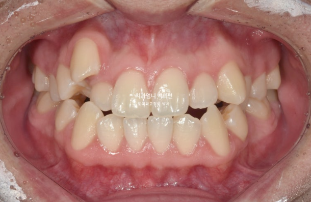 투명교정 인비절라인 덧니 교정 치료기간 알아보기 관련 이미지 2