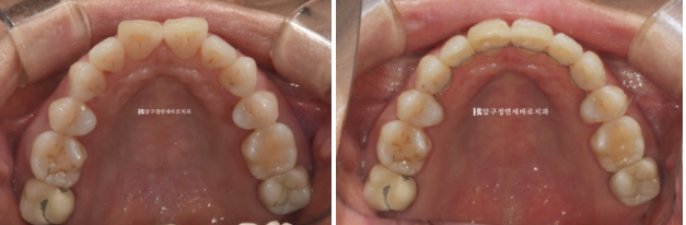 50대 중년교정, 잇몸이 약해도 인비절라인이 가능할까요? 관련 이미지 11