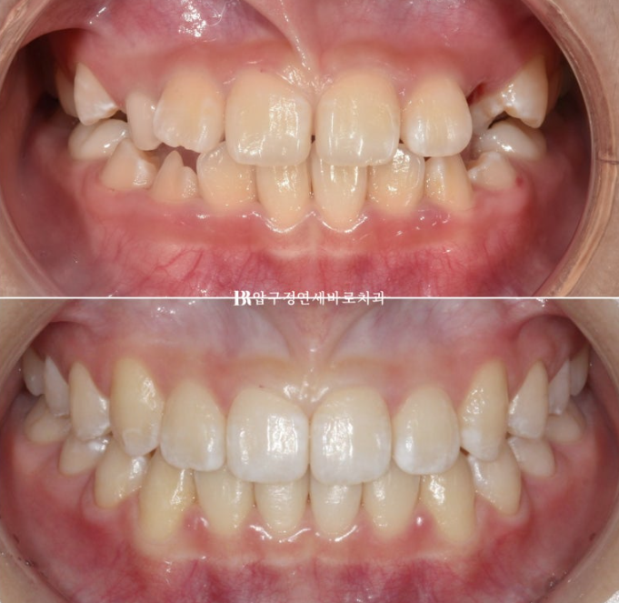 Simultaneous Arch Expansion and Teeth Alignment for Elementary School Children with Invisalign｜Invisalign First image 1
