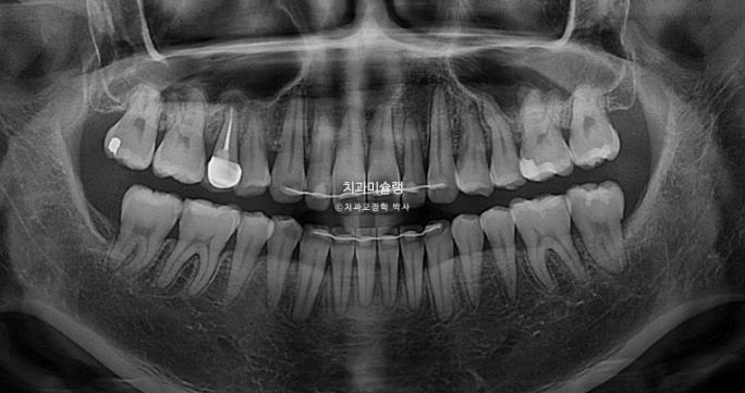 비발치 인비절라인 교정 편측 개방교합 가위교합 돌출 재교정 관련 이미지 25