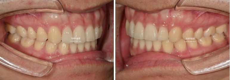 옥니 덧니 교정 왜소치 선천적 결손 3전치 무삭제 라미네이트 인비절라인 교정 관련 이미지 16