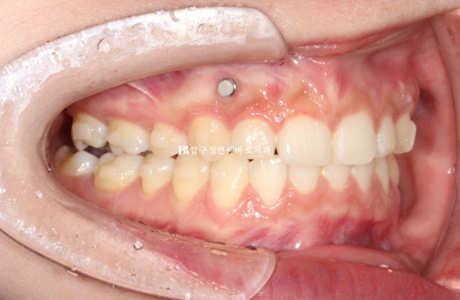 인비절라인 돌출입 발치교정 거미스마일 잇몸미소 교정 관련 이미지 8
