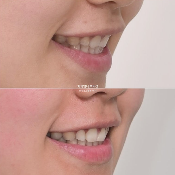 과개교합 옥니 거미스마일 교정 인비절라인 라이트 잇몸성형 후기 관련 이미지 19