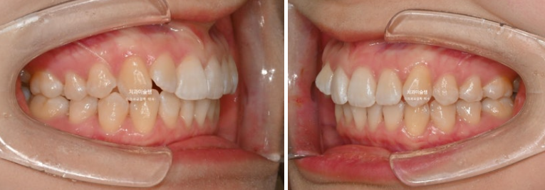 덧니 인비절라인 라이트 잇몸미소 거미스마일 중심선 블랙트라이앵글 관련 이미지 3